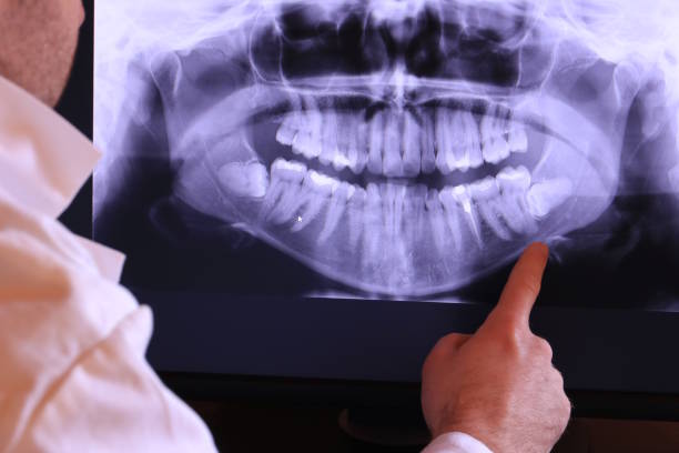 Best Emergency Wisdom Tooth Extraction in Coal City, WV