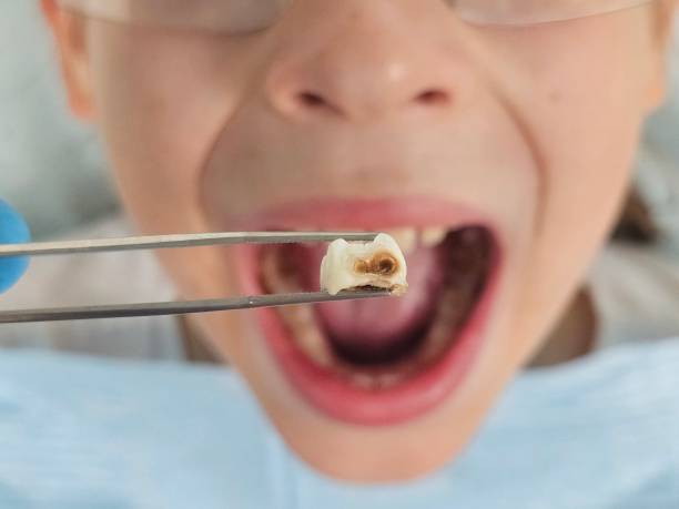 Best Knocked-Out Tooth (Avulsed Tooth) Treatment in Coal City, WV